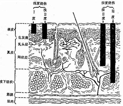 烧伤深度的三度四分法组织学示意图