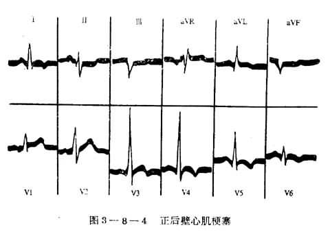 心肌梗塞的心电图定位诊断
